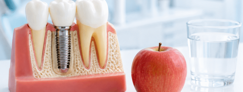 Ce mănânci după implant dentar – ilustrație cu implant dentar, măr și apă