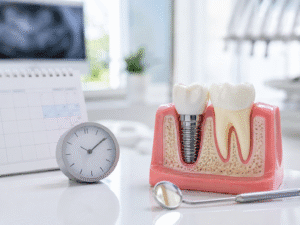 Recuperare după implant dentar – ilustrație cu model dentar, ceas și instrument stomatologic